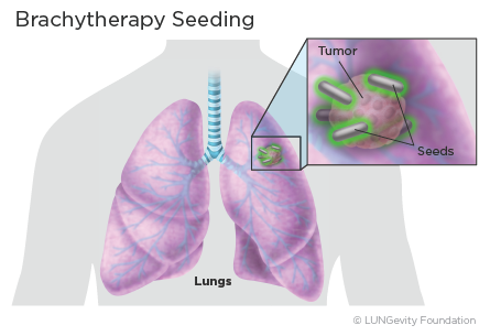 radiation therapy diagram