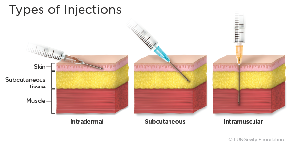 4 Types Of Injection