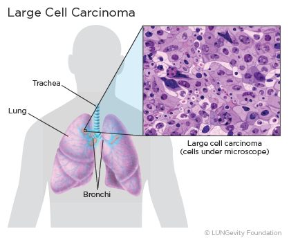 Small Cell Lung Cancer Histology
