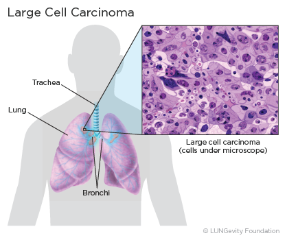 lung cancer cells