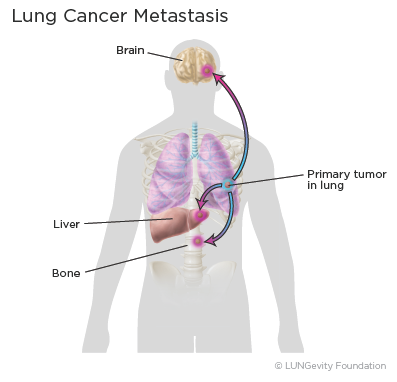 cancer metastatic to lung)