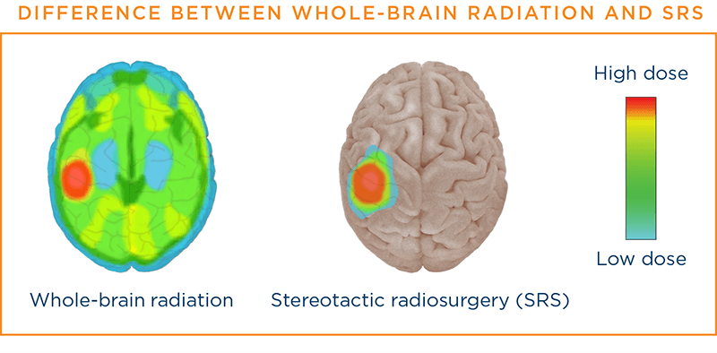 Difference between whole-brain radiation and SRS