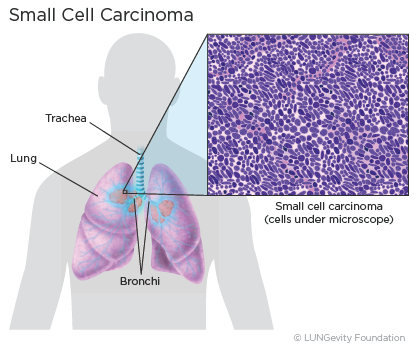 case study on small cell lung cancer