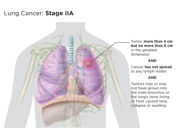 Lung cancer: stage IIa