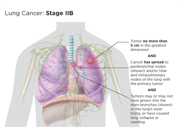 Stages of developing lung cancer, in summary (Modified from