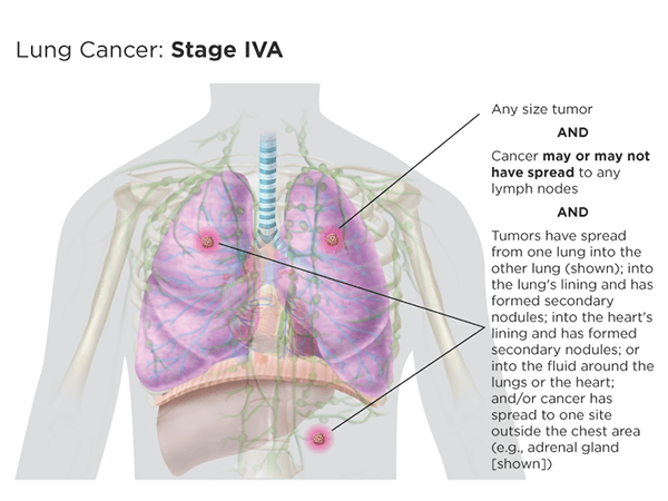 Lung Cancer Staging | LUNGevity Foundation