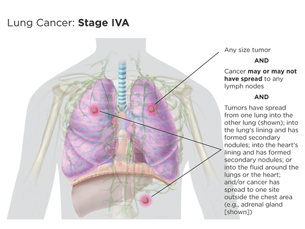 Tumor Size Chart Lung Cancer