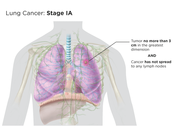 Lung cancer: stage Ia